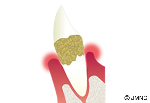[歯周炎]末期