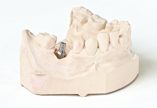 3 インプラントと歯の結合（治癒期間）
